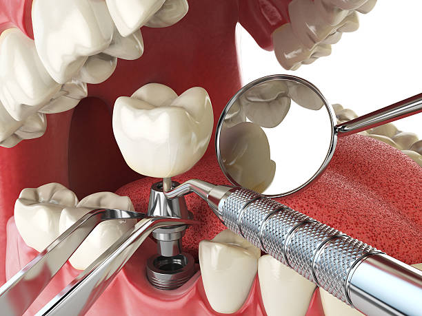 Best Dental Abscess Treatment in Ahtanum, WA